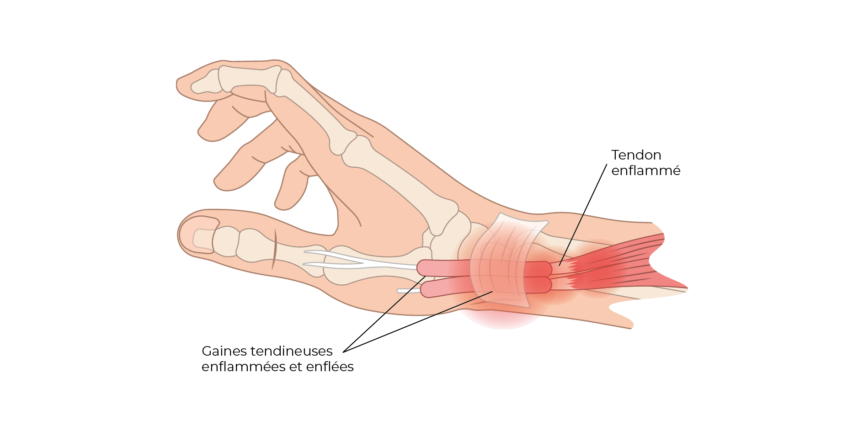 Tendinite de De Quervain: tendinite au poignet - Membre-Superieur